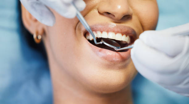 Best Emergency Wisdom Tooth Extraction in Isla Vista, CA